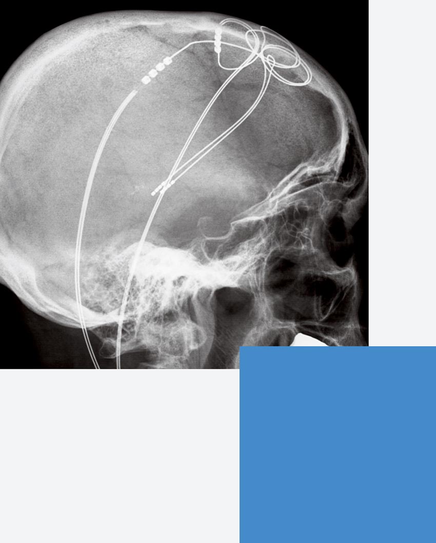 X-Ray of a human skull with an electrode on the brain.