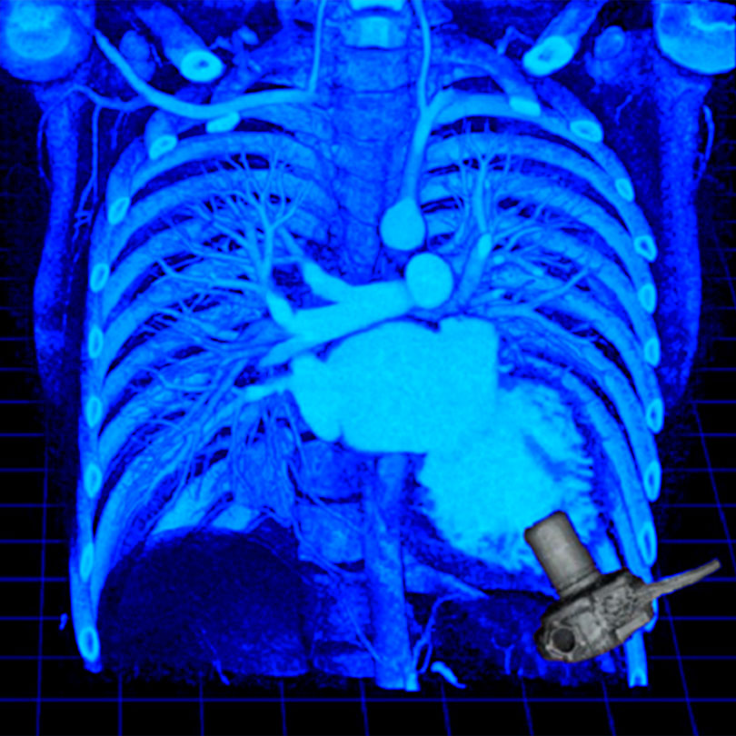 C-ray imaging of a heart and lungs with a 3d virtual model of a ventricular assist device.