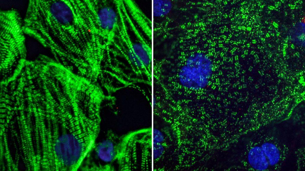 Two images of heart muscle cell: Healthy heart muscle (left) created from adult stem cells have long fibers which allow them to contract. SARS-CoV-2 infection causes these fibers to break apart into small pieces (right), which can cut off the cells ability to beat and may explain lasting cardiac defects in COVID-19 patients.