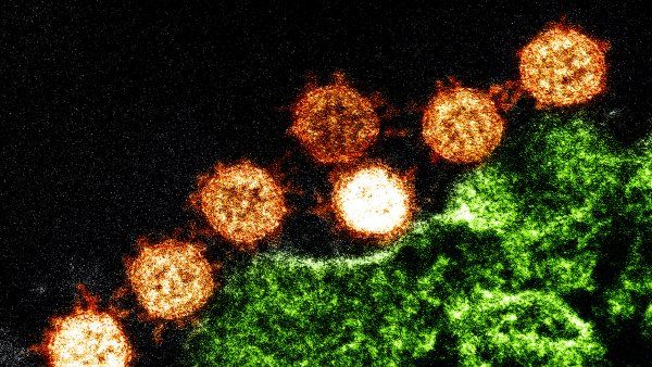 Microscopic image of SARS coronaviruses