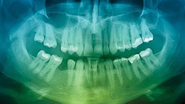 An x-ray of teeth