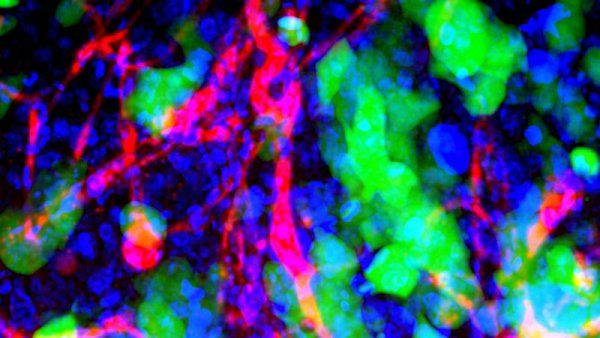 Blood vessels (red), cell nuclei (blue), and human metastatic breast cancer cells (green) in a mouse's brain