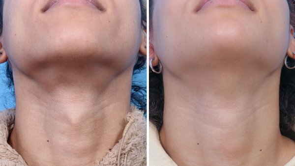 Side by side view of patient who underwent adam's apple surgery. Left image is before surgery, and the right image is after. There is no neck incision scar.
