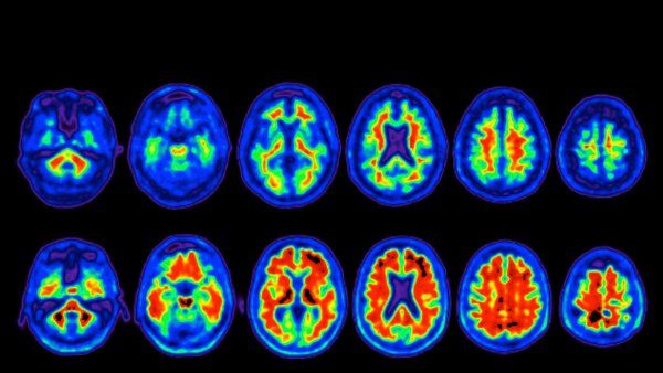negative amyloid PET scan of brain