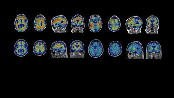 A set of 16 brain PET scans, with orange areas representing Alzheimer's progression