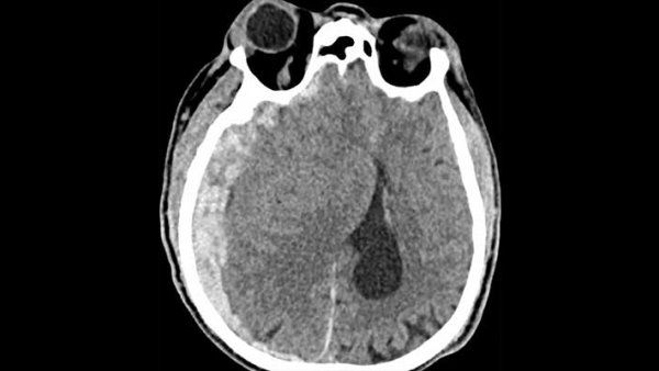 A CT scan of a traumatic brain injury.