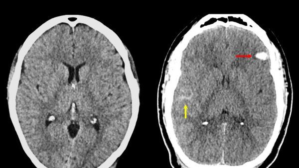Two brain scans featuring brain injury.