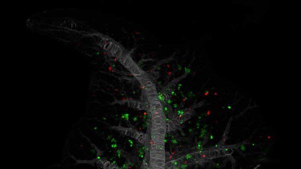 Microscopic image showing metastatic pancreatic cancer cells in a lung.