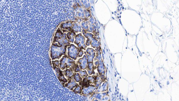A microscopic image showing micropapillary bladder cancer.