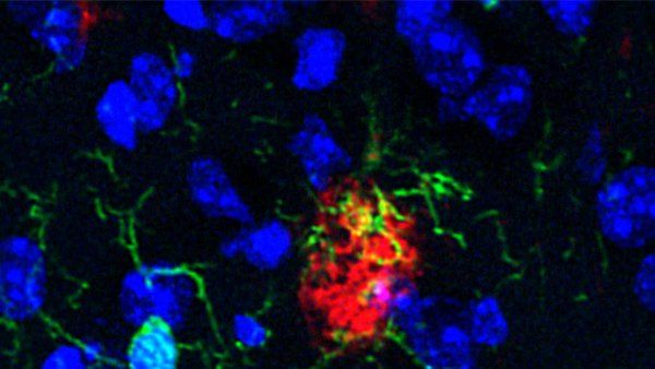A fluorescent microscope image shows blue cell nuclei, green branching structures called microglia, and red clusters that are amyloid beta plaques.