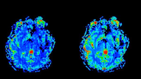 MRI scans of a brain.