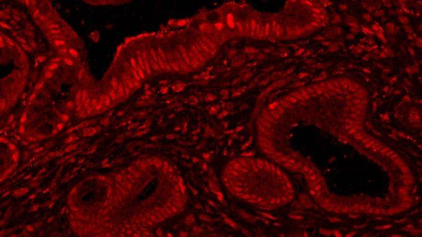 A microscopic image showing the presence of the M Y C protein in a pancreatic biopsy. M Y C is shown in red among a black background.