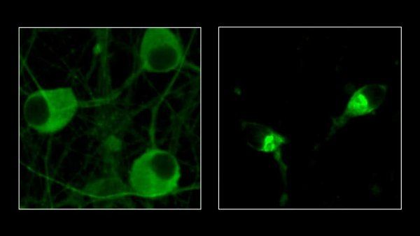 Two side-by-side microscopic images showing healthy neurons, and neurons with the protein tau that are a hallmark of Alzheimer's disease.