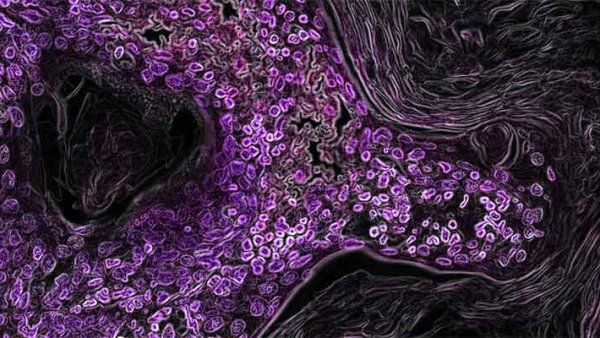 Microscopy image of purple-stained lung cancer cells.