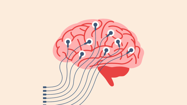 A conceptual illustration depicting wires hooked up to a brain that is under going an electroencephalogram (EEG).