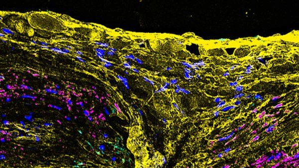 Fluorescent microscope image of a cross-section of a brain aneurysm.