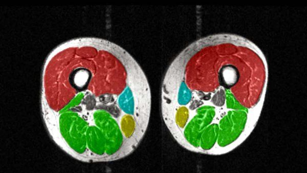 MRI image of the thighs with color-coded muscle groups, showing less muscle volume.