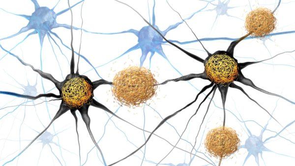 Conceptual illustration of amyloid beta and tau tangles as abnormal clusters of protein fragments that accumulate between nerve cells and inside neuron cells in the brain resulting in degenerative disease as Alzheimers and dementia.