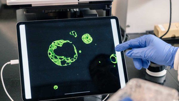 An iPad screen displaying breast cancer organoids, which are green round and crescent shapes on a black background.