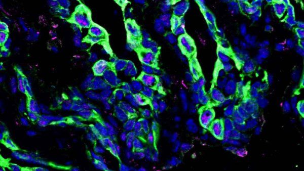 Fluorescent microscopy image of a soft mammary tumor showing relatively little pSTAT3 signaling in pink among green and blue cells.