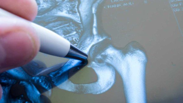 A pen points at a hip joint.
