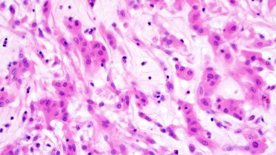 chordoid_glioma_histology.jpg
