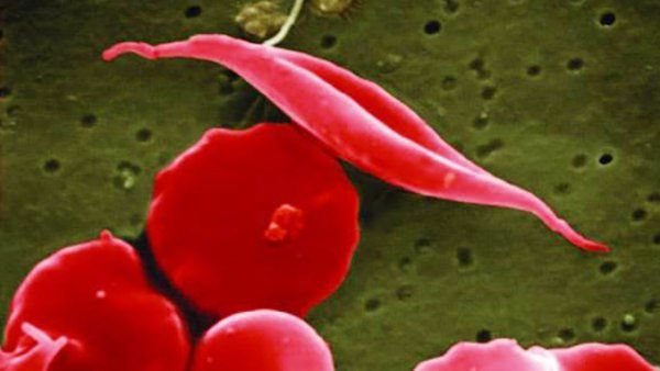 sickle_cell.jpg