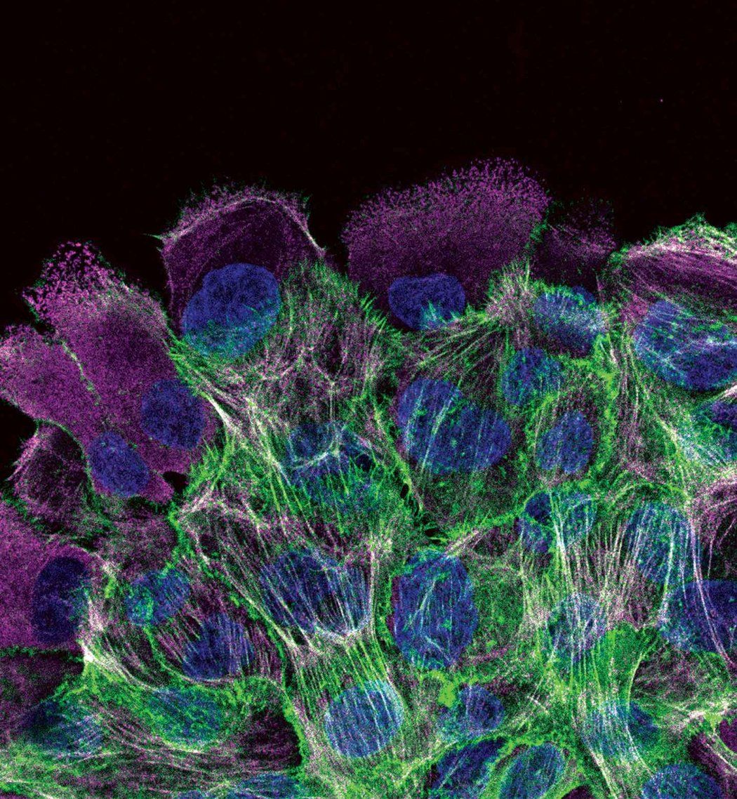 Microscopy image of human breast cancer tissue