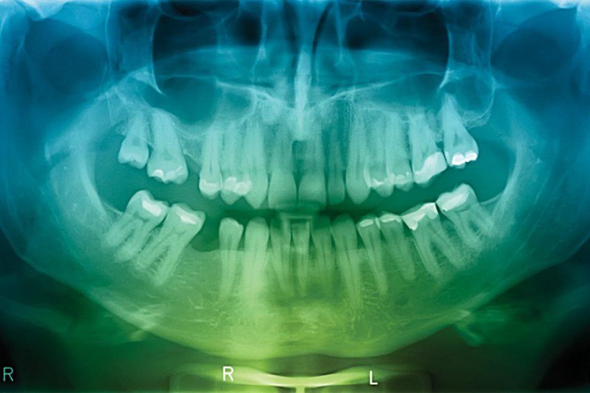 An x-ray of teeth