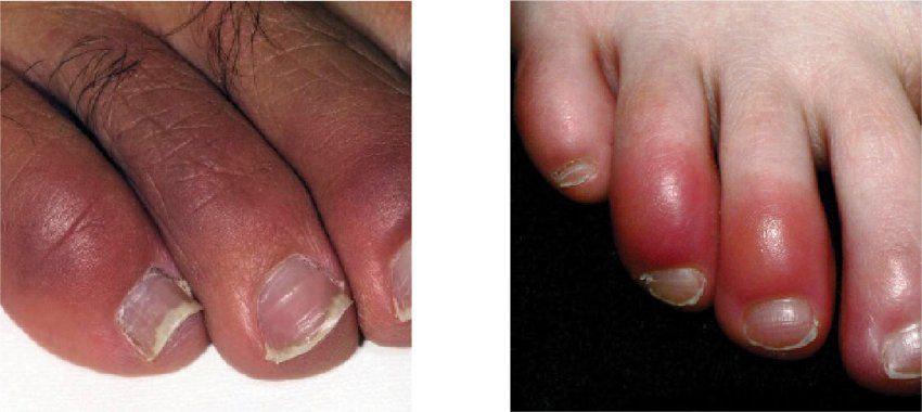 Two examples of "COVID toes", one on dark skin and one on light skin.