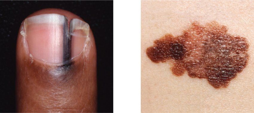 Two examples of melanoma, one on light skin, one on dark skin.